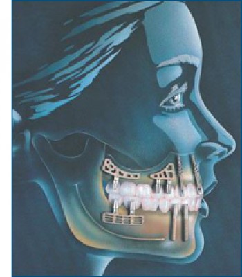 implant.jpg